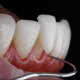 Dental Veneers