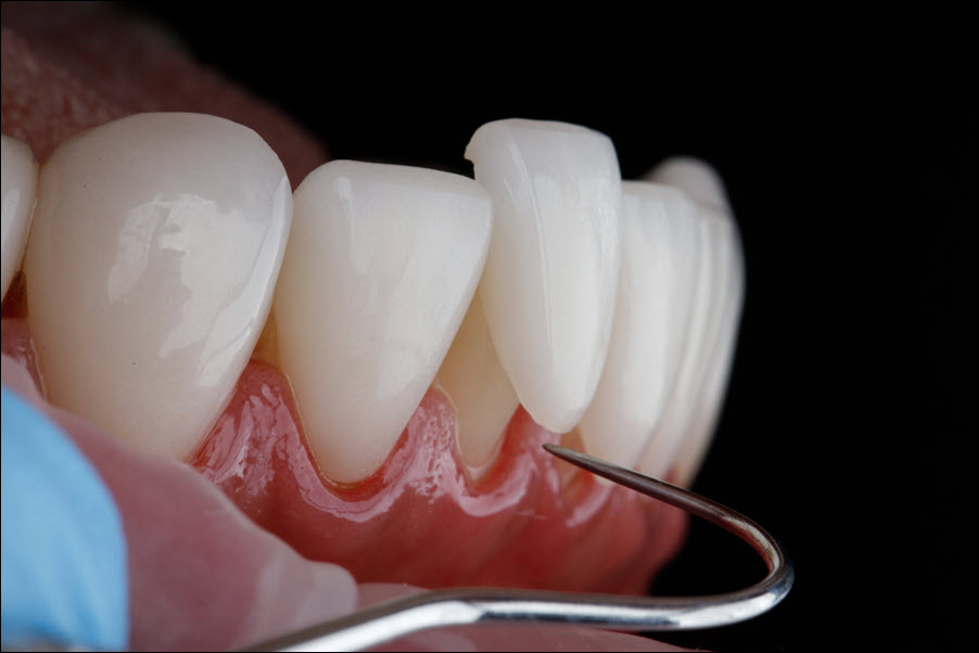 Dental Veneers