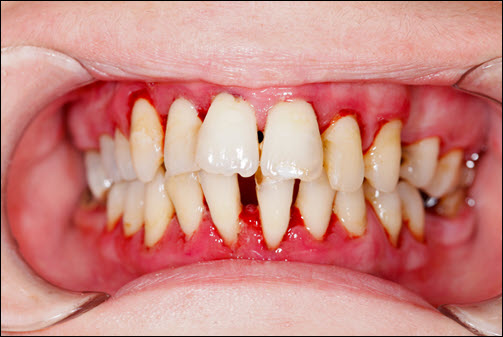 Gum Disease