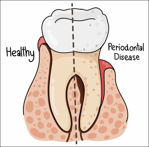 Gum Disease