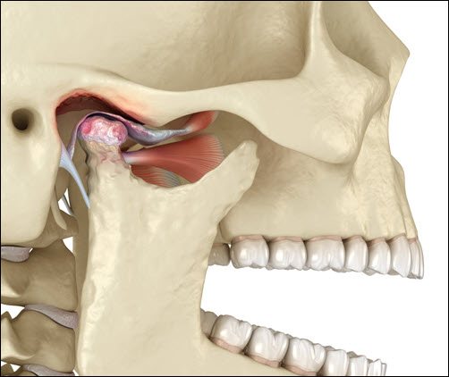 TMJ Disorders